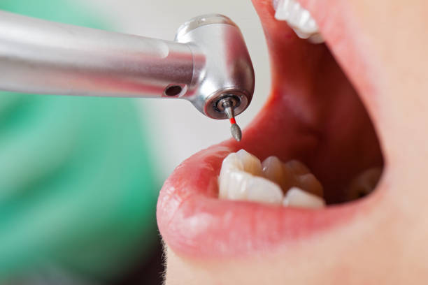 Best Emergency Wisdom Teeth Removal in Burton, SC